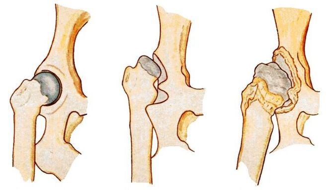 Hip dysplasia is the cause of secondary coxarthrosis