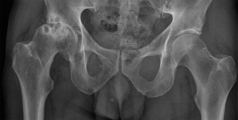 Stage 3 hip arthrosis on X-ray