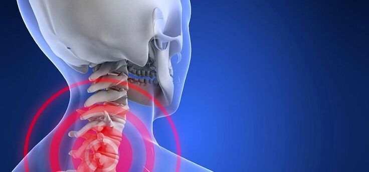 The cervical region osteochondrosis