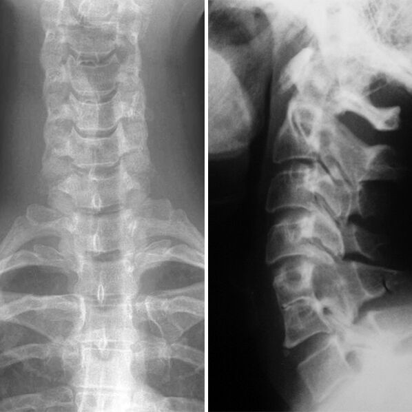 X -sere of the cervix's spine
