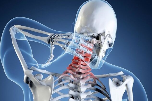 The cervical region osteochondrosis