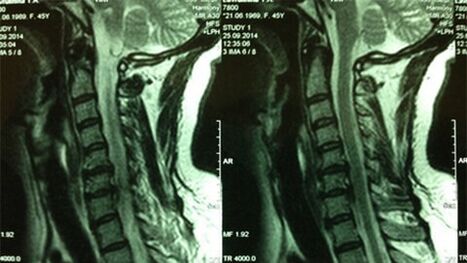 The cervix class is MRI