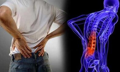 The causes of the formation of lumbar osteochondrosis