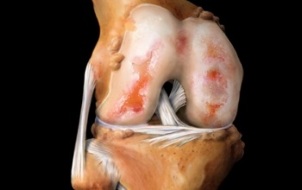 what is knee arthrosis