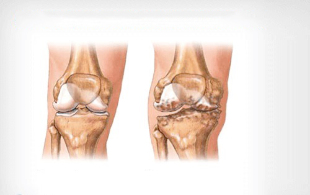 knee arthrosis