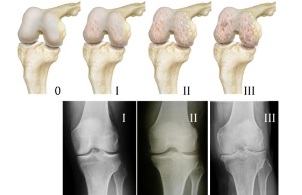 methods for diagnosing knee arthrosis