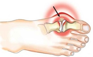 Inflammation of the joint between the thumb and the foot in arthritis
