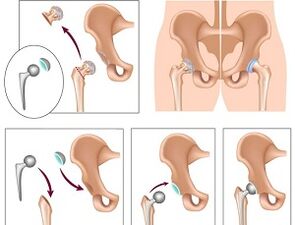 joint surgery for arthrosis of the hip joint