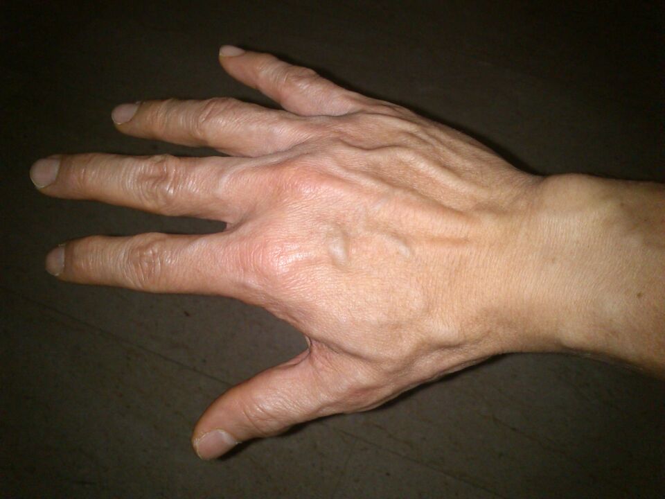 deformity of bones and pain in the joints of the fingers