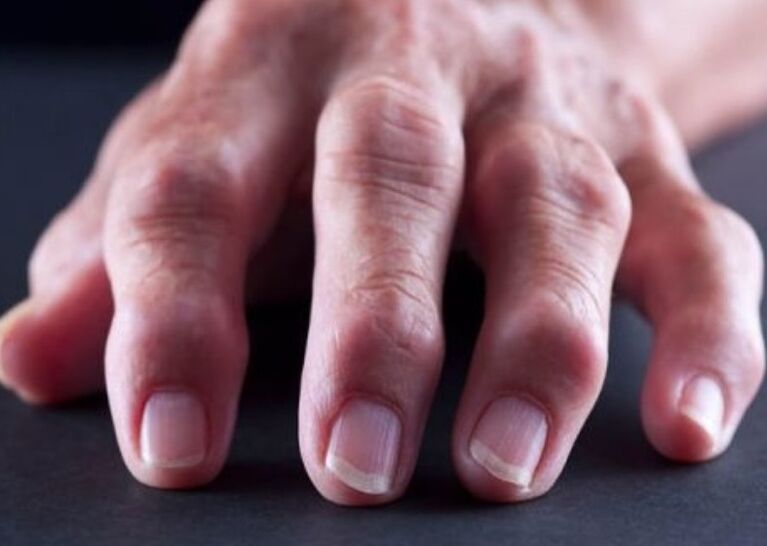 rheumatoid arthritis as a cause of joint pain in the fingers
