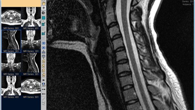 Cervical spine MRI is the best way to diagnose cervical pain