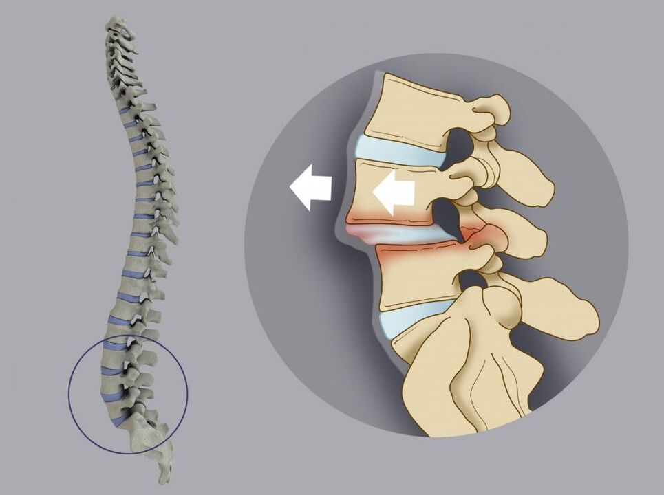movement of the vertebrae as a cause of back pain